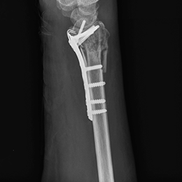 X-ray of distal radius plate