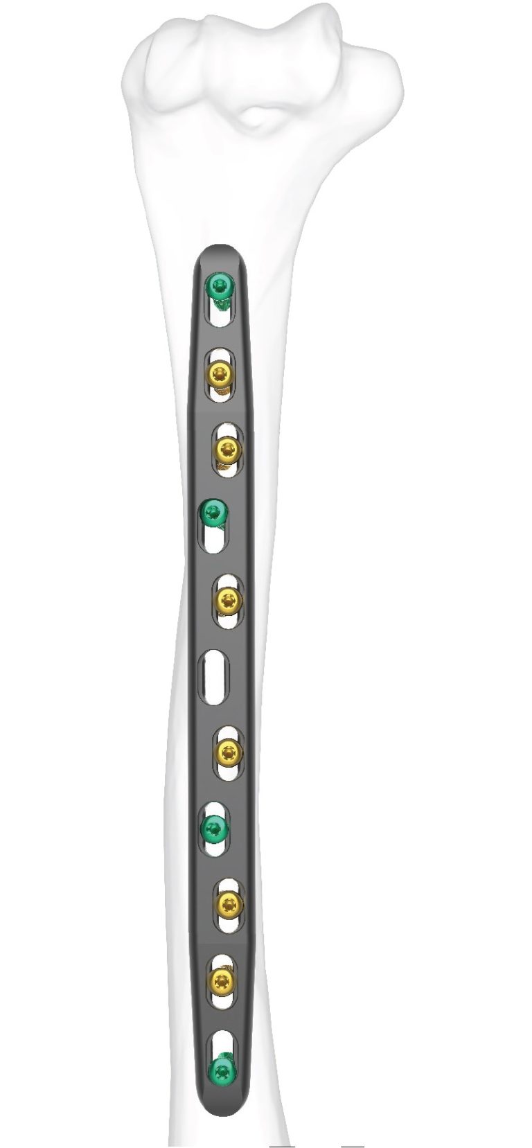 FREEFIX® Humeral Fixation Set - Skeletal Dynamics