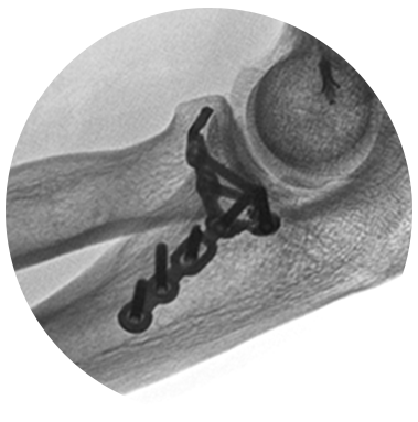 Protean® Fragment Plate X-Ray