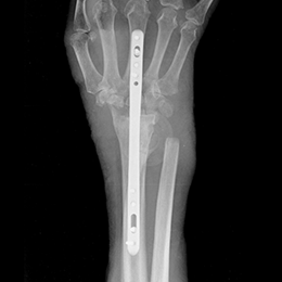 Dorsal Spanning Plate X-Ray 01