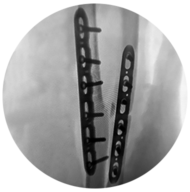 FREEFIX® Forearm plating xray
