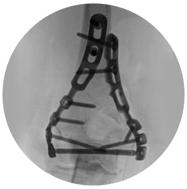 Humeral Fixation Set X-ray