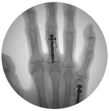 Locking Hand Nail System X-ray
