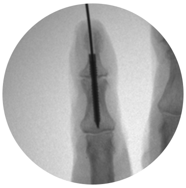 Reduct Arthrodesis Screw X-ray