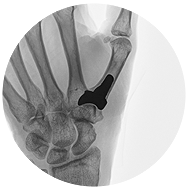 Stablyx X-ray