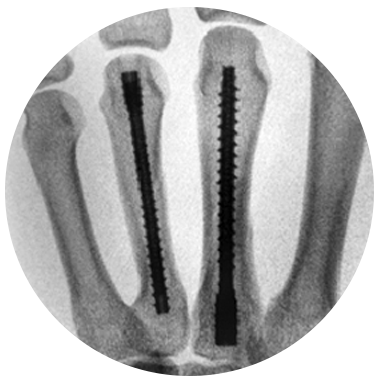 Threaded Hand Nail System X-ray