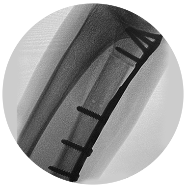 Ulna Shortening Plate X-ray