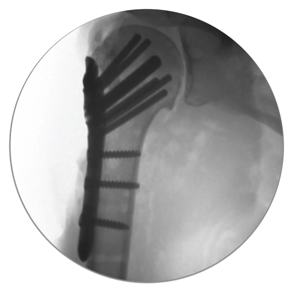 Side X-Ray view of the Proximal Humerus Fixation System