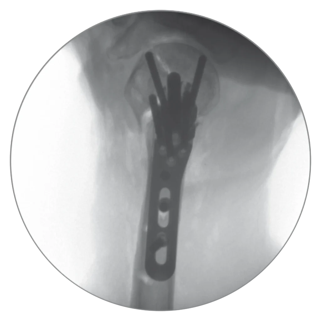 Top X-Ray view of the Proximal Humerus Fixation System