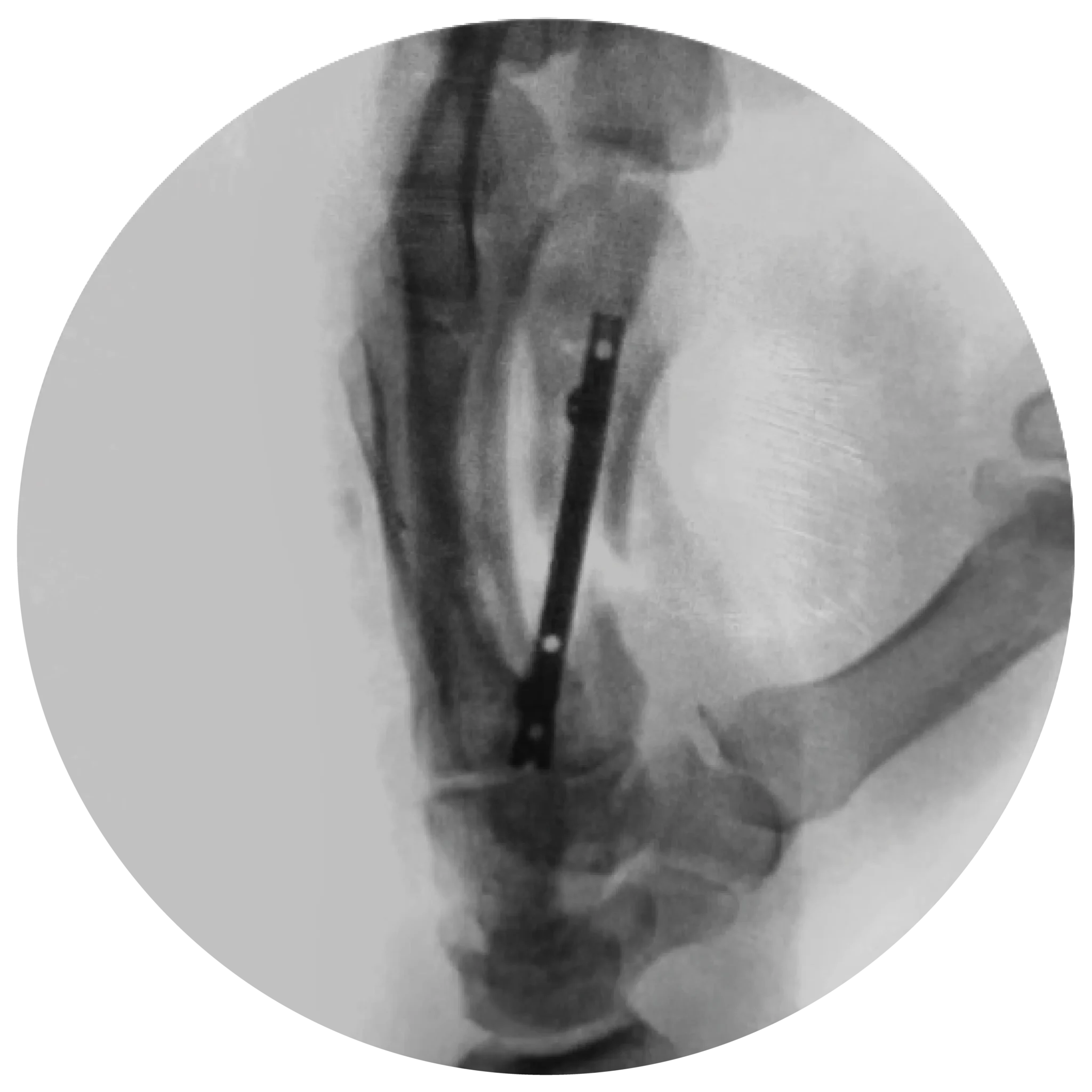 Locking hand nail system x-ray 2