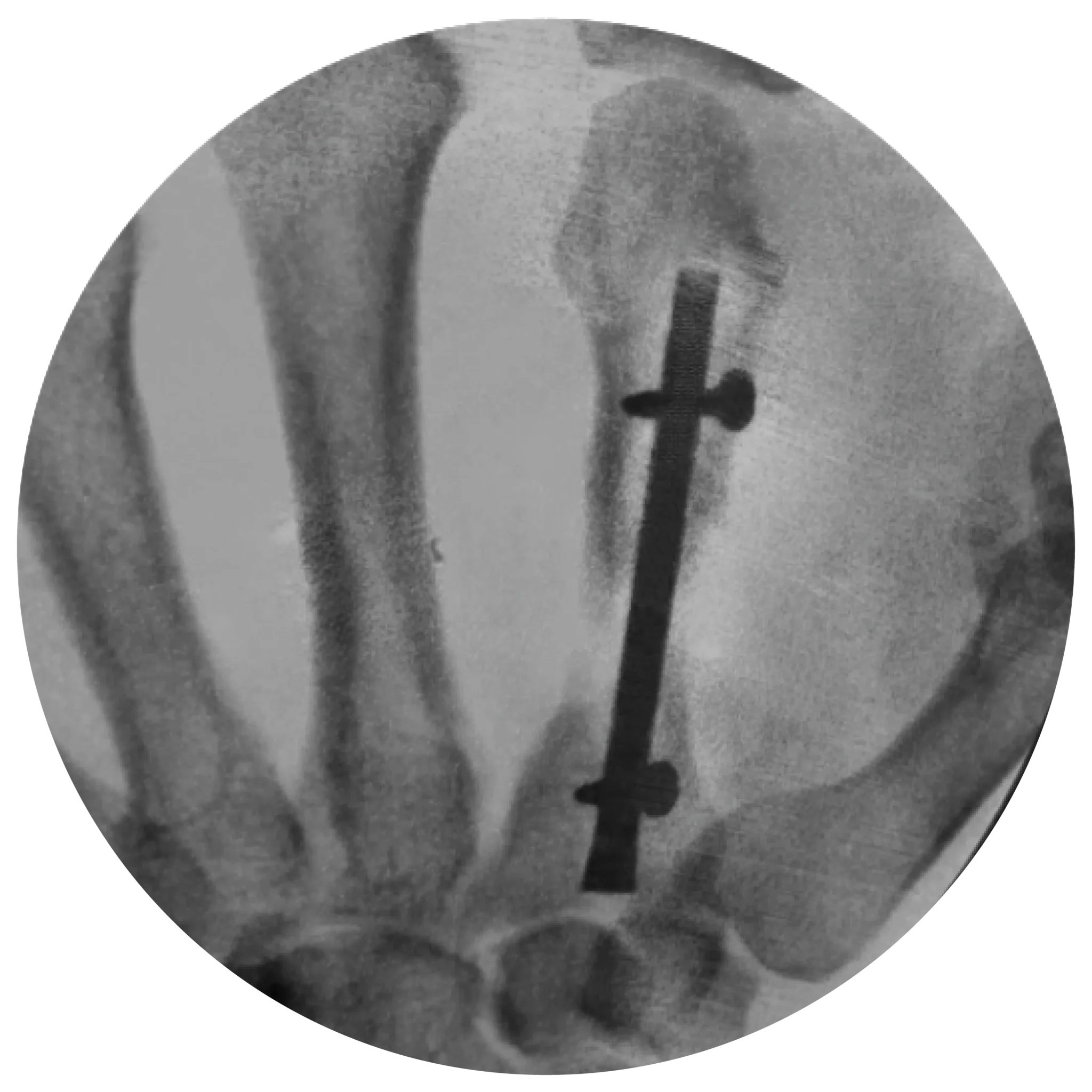 Locking hand nail system x-ray 3