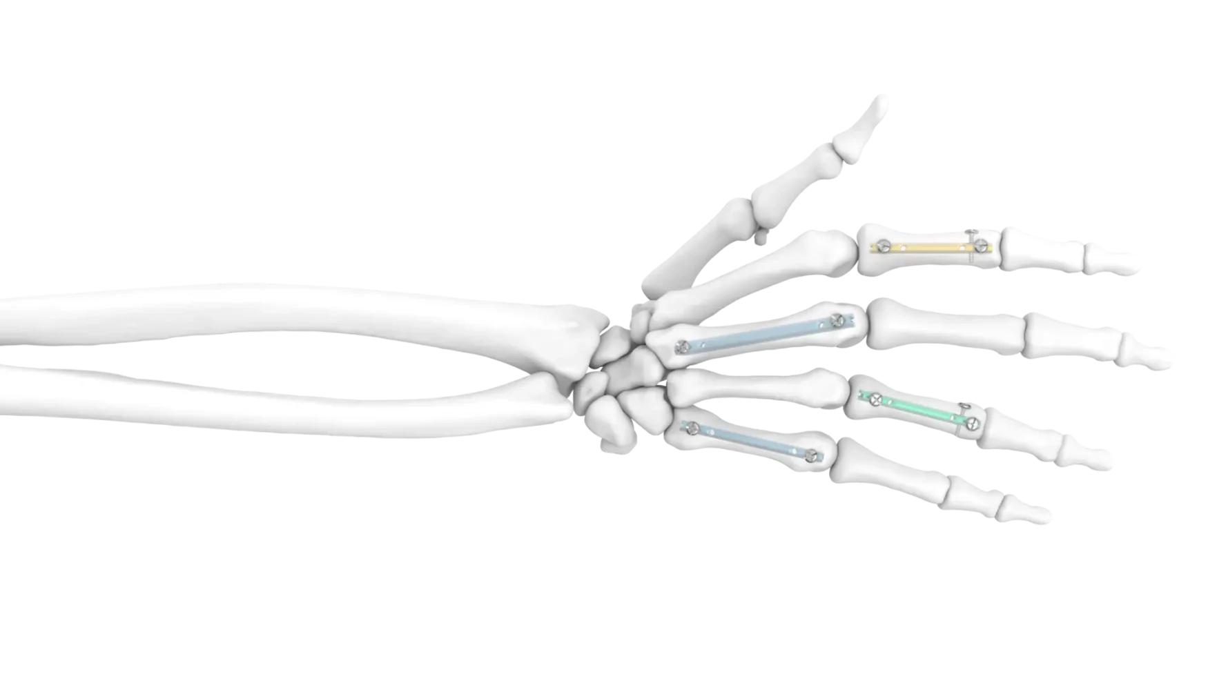 Locking Hand Nail System