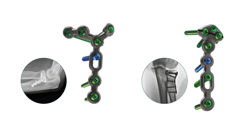 Radial Styloid plate and Coronoid Plate
