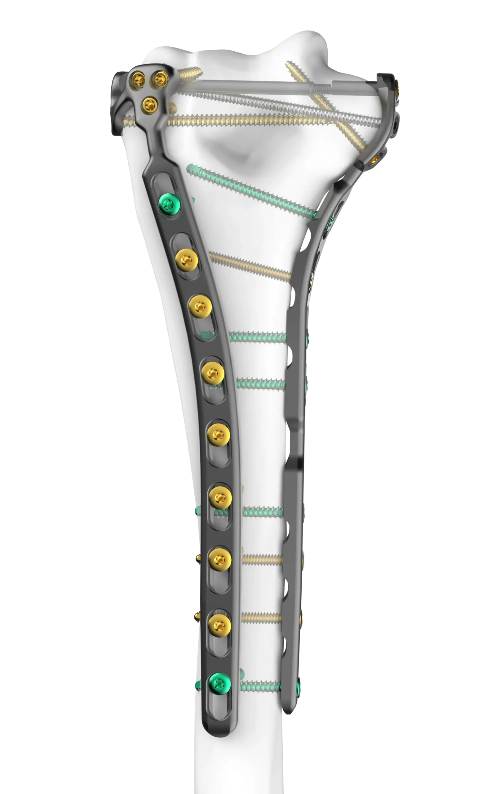 Humeral Fixation Set Capitellar with Medial Direct Plates