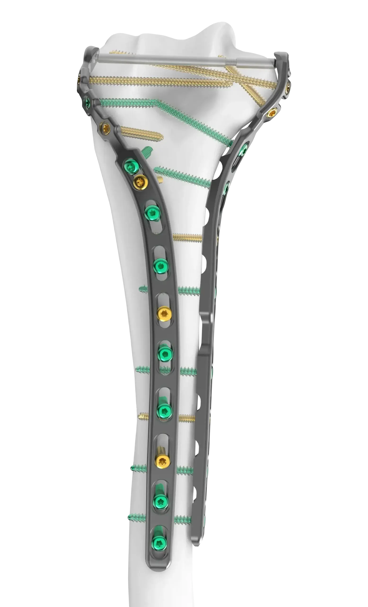 Humeral Fixation Set Helical with Medial Direct Plates