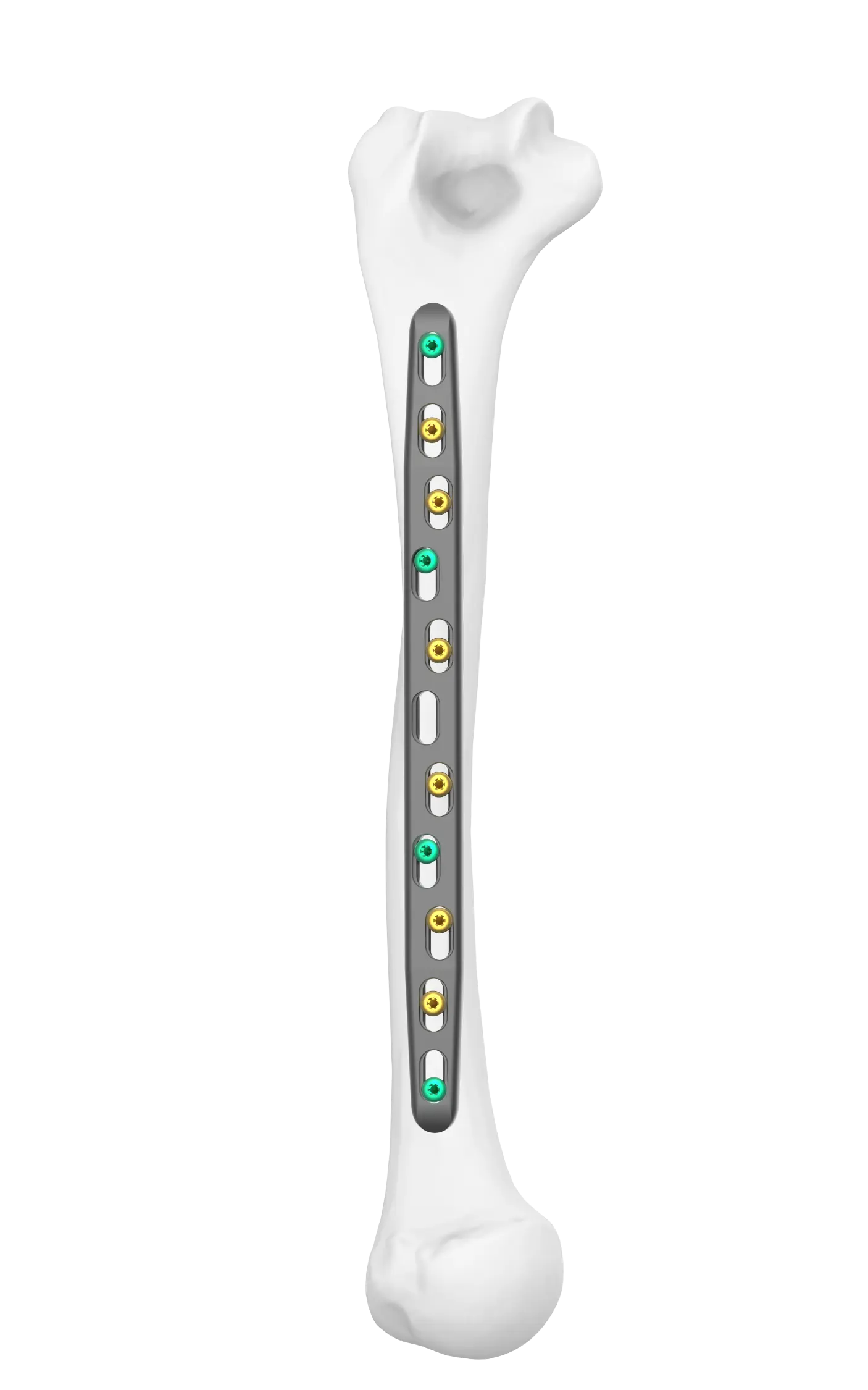 Midshaft Broad FreeFix Humeral Fixation