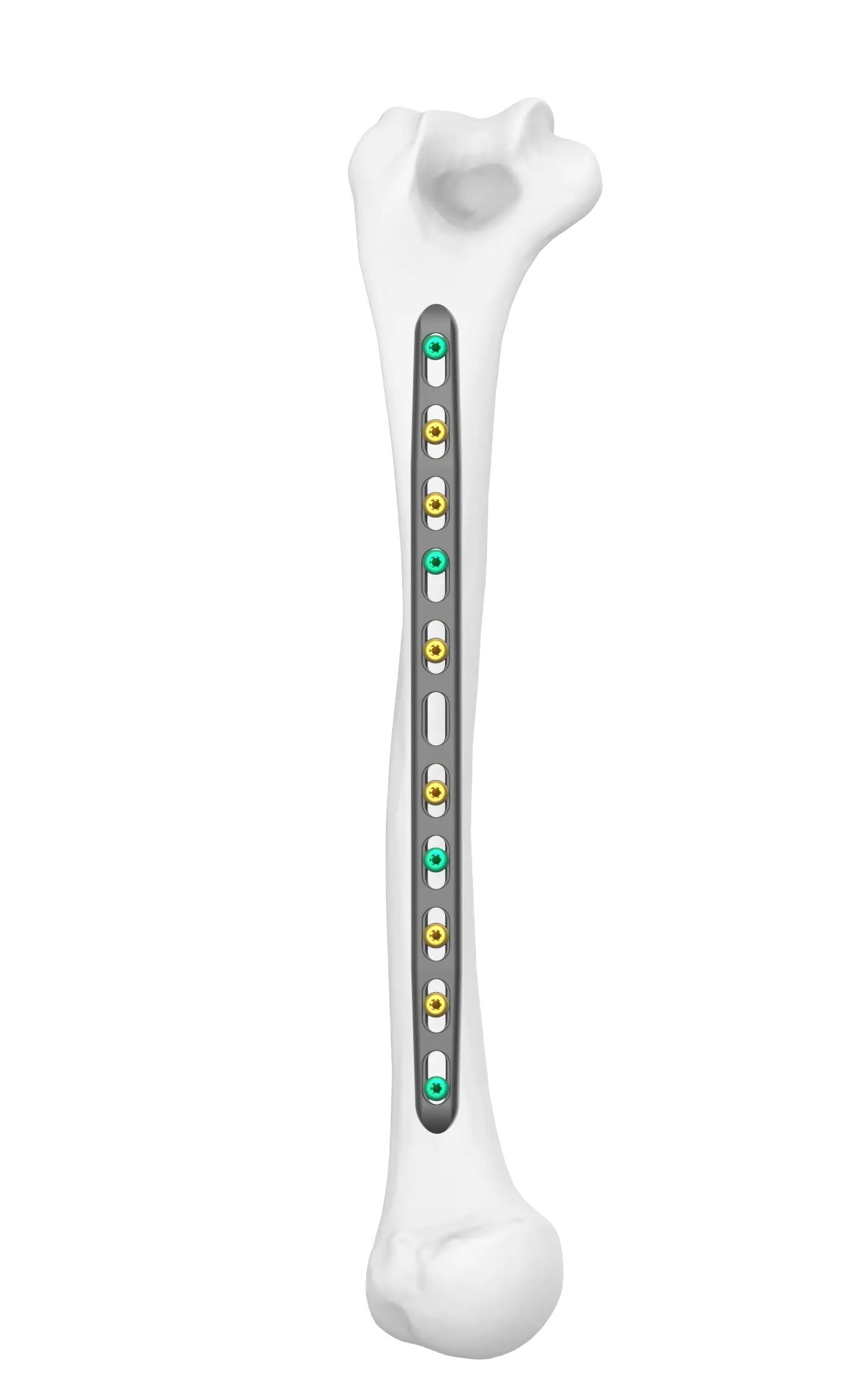 Midshaft Narrow FreeFix Humeral Fixation