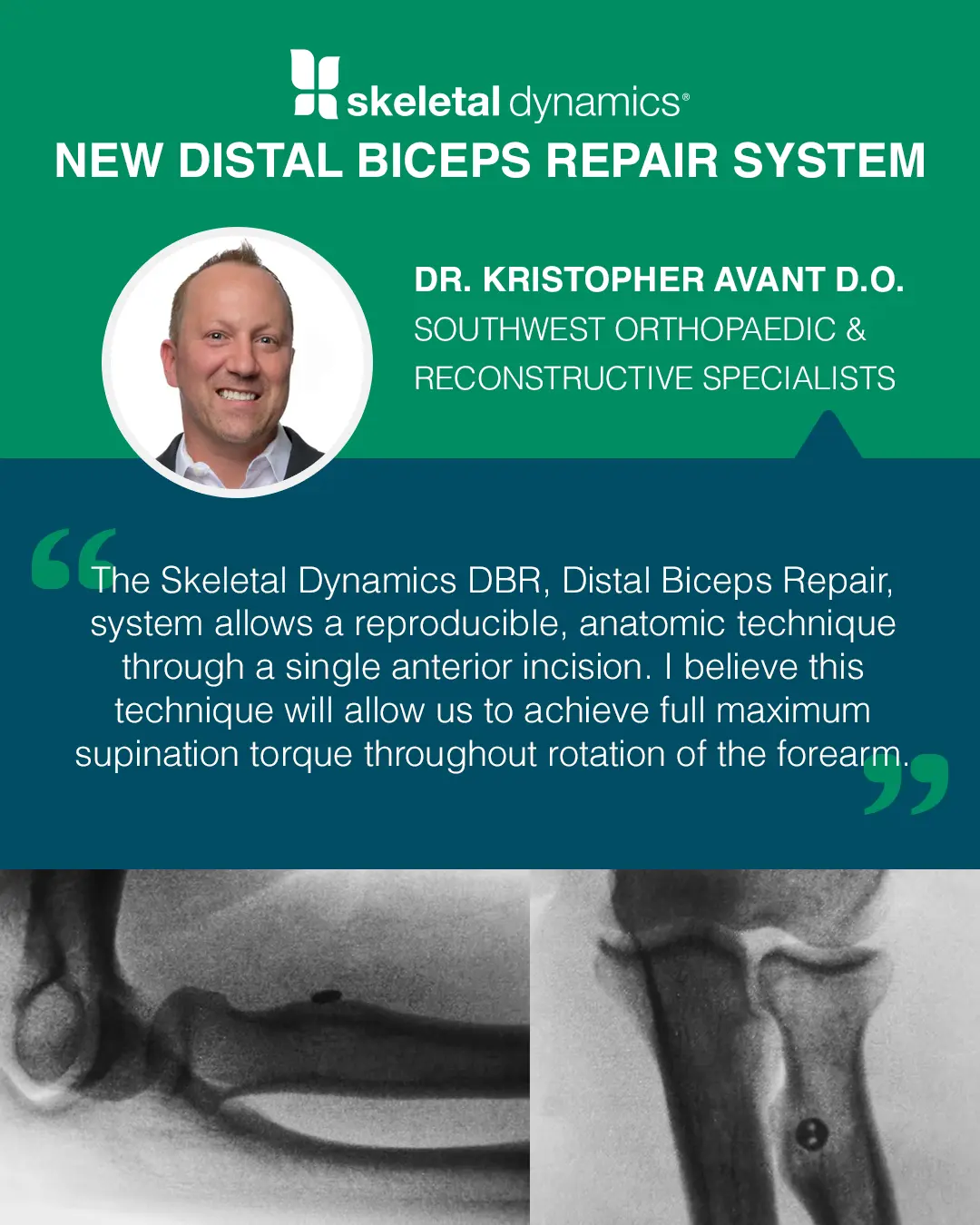 Dr. Kirstopher Avant distal biceps repair system quote