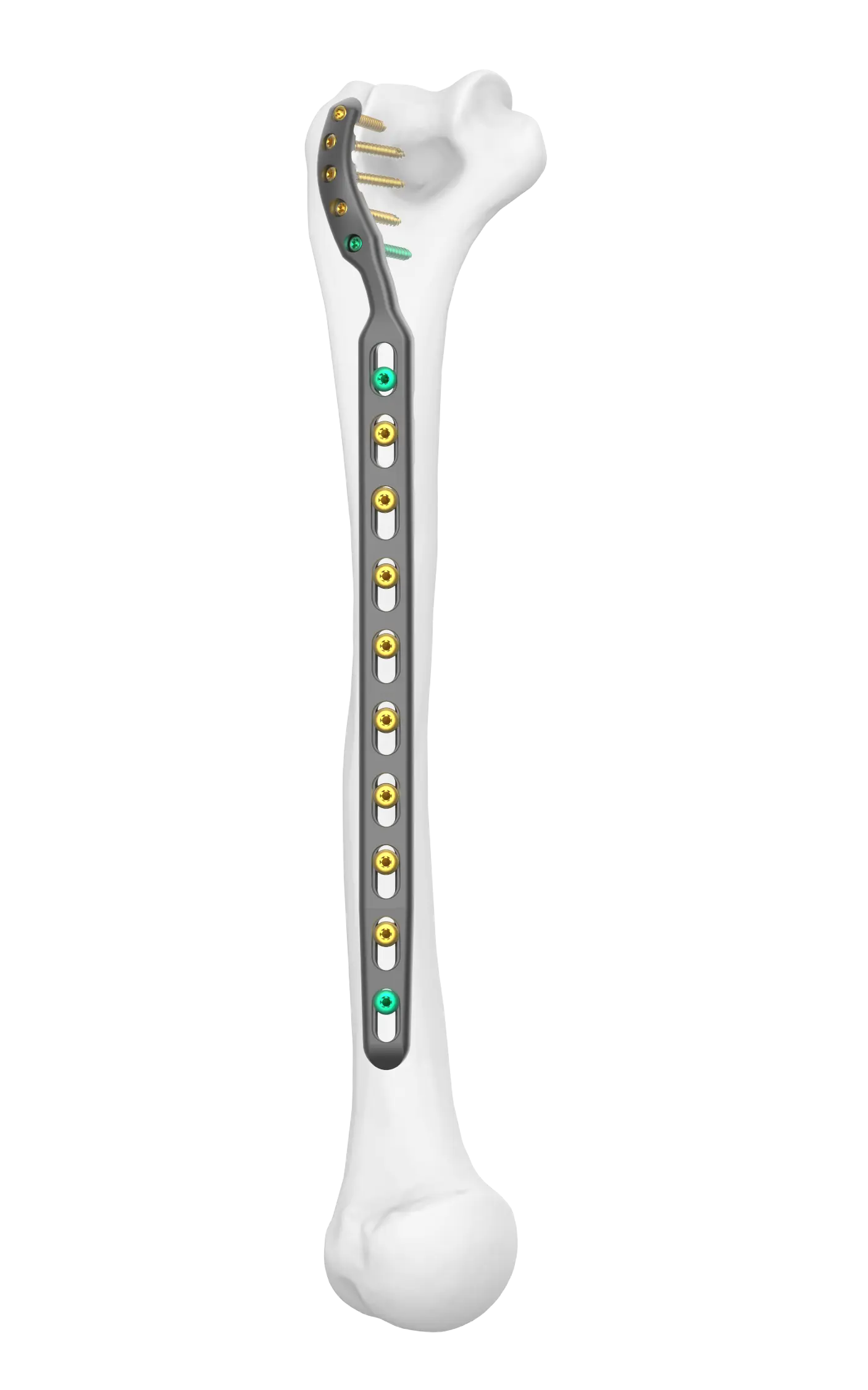 Supracondylar FreeFix Humeral Fixation