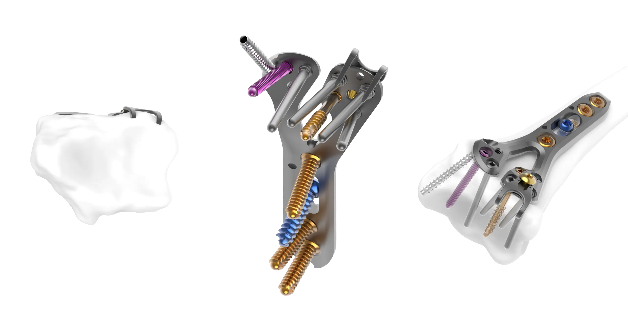 Hook plate option allows extending fixation to secure volar marginal fragments​