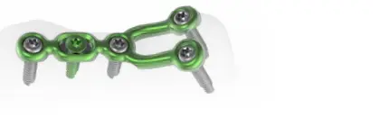 Precision guided correction and fixation created to preserve the CMC joint.
