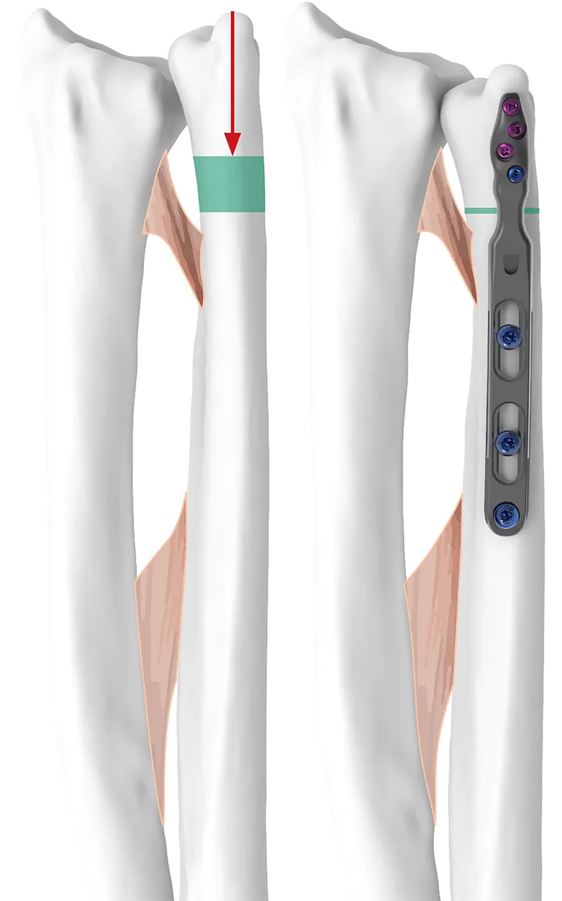 Metaphyseal location facilitates healing and maintains normal distal interosseous ligament tension