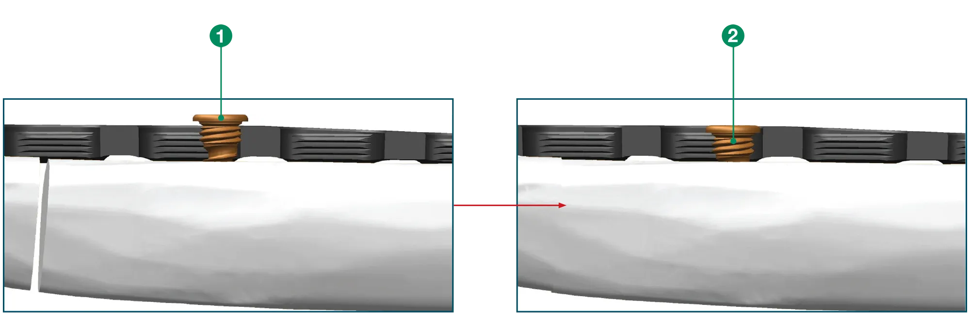 Head of the screw engages the plate, compressing the fracture and engages the locking screw.