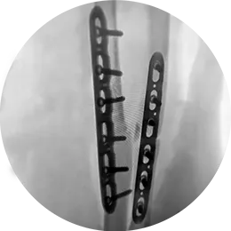 X-ray view of the specific options for the radius and ulna
