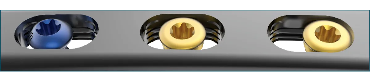 FREEFIX® technology allowing the fracture to dictate screw placement