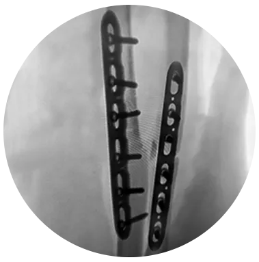 FREEFIX® Forearm plating xray