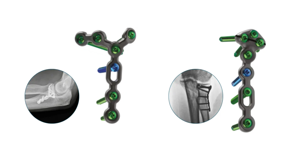 Radial Styloid plate and Coronoid Plate with both technology and x-ray views