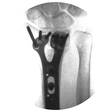 GEMINUS® Volar Plating System xray