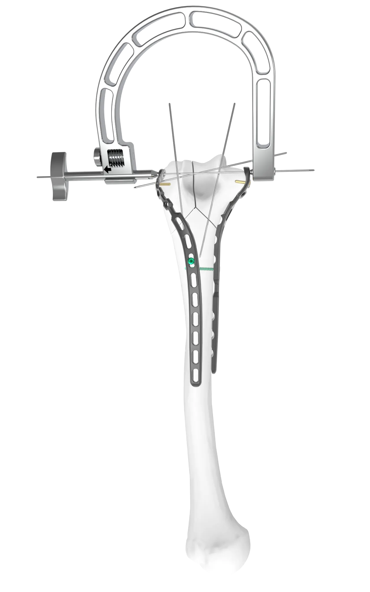 Step 1 of TiBeam® technology.