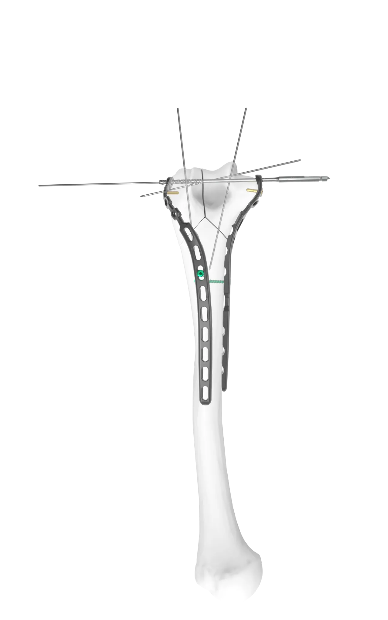 Step 2 of TiBeam® technology.