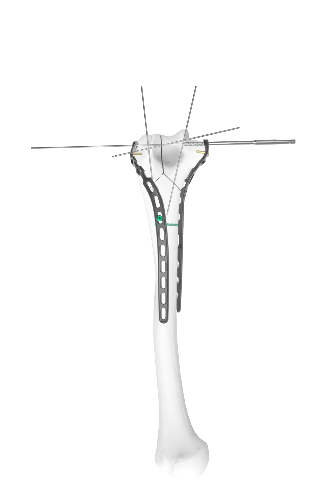 Step 3 of TiBeam® technology.