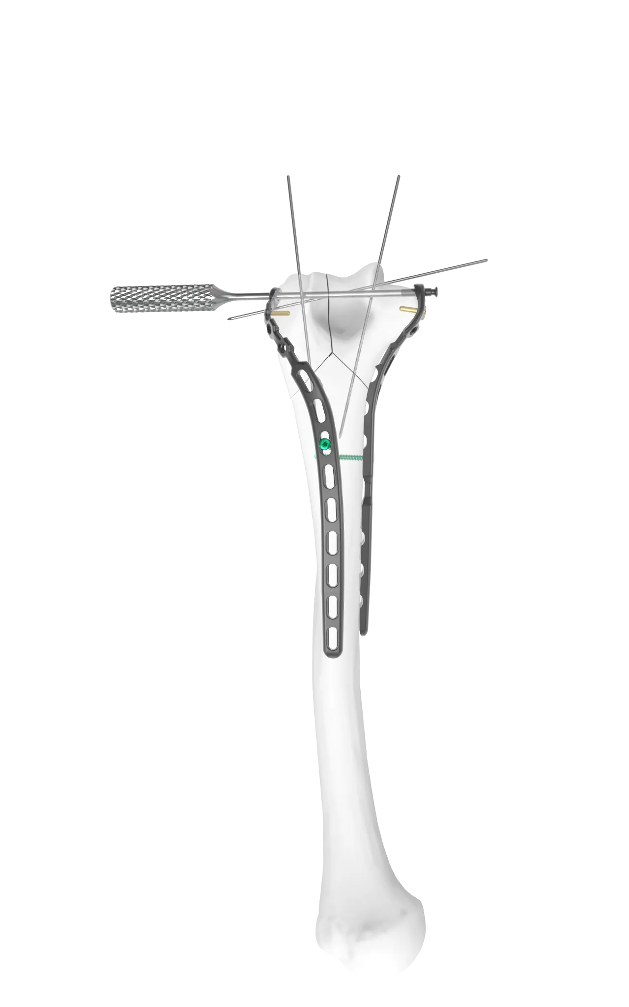 Step 4 of TiBeam® technology.
