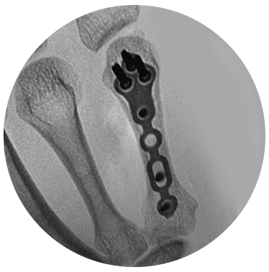 PROTEAN® hand plating system X-Ray