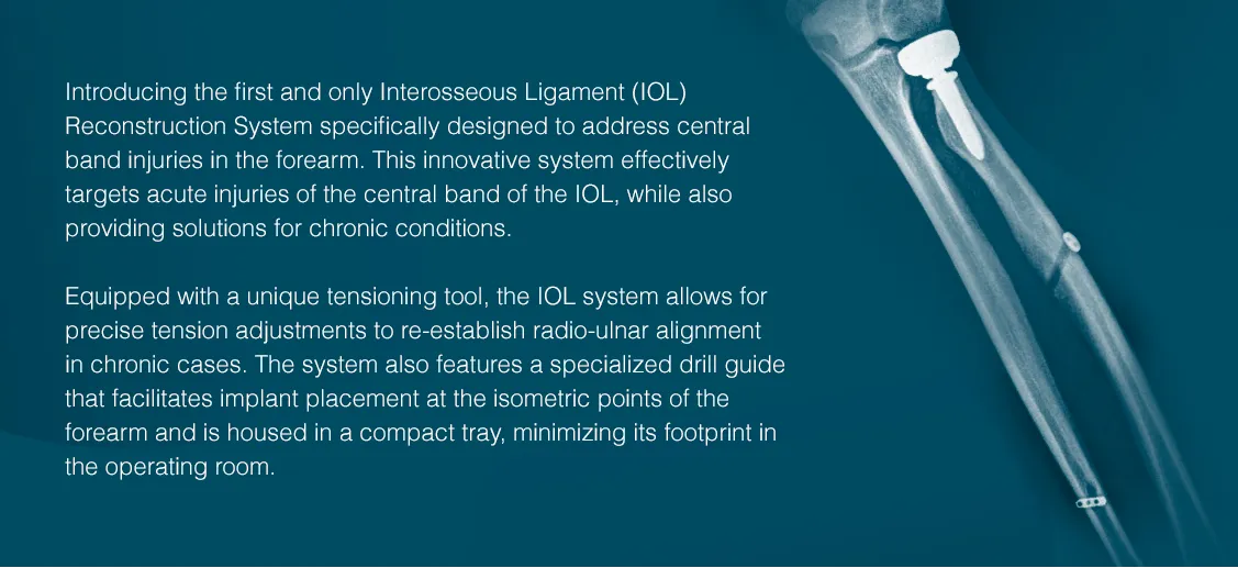 Introduction to the Interosseous Ligament Reconstruction System