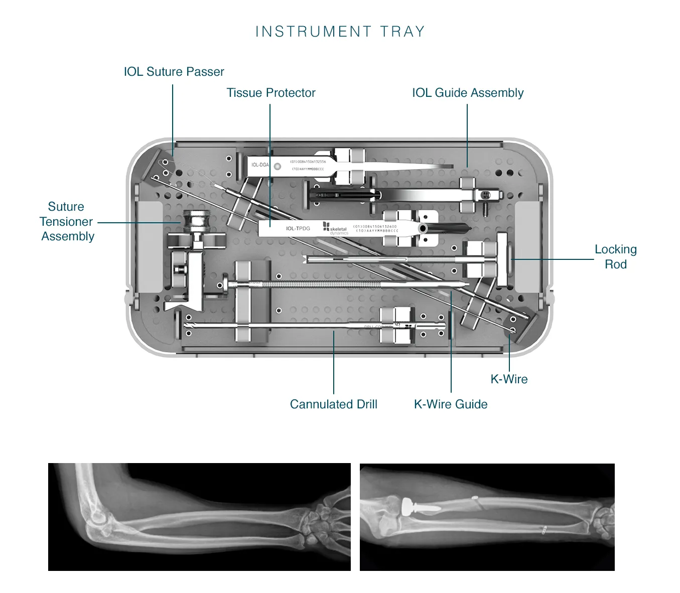 The instrument tray used in Ligament Reconstruction procedures.