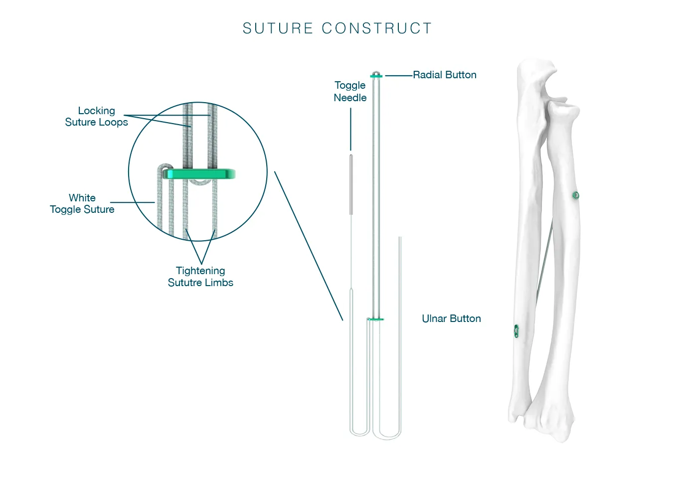 Suture Construct diagram in relation to an anatomically accurate forearm bone.
