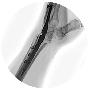 IMPLATE® Wrist Arthrodesis Nail xray