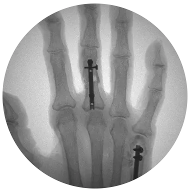 Locking Hand Nail System X-ray