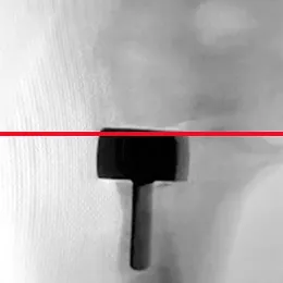 Static Monoblock Implant in supination (or, outward rotation).