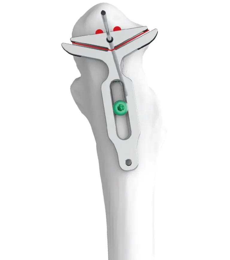 Technology that aligns and secures the osteotomy guide diagram