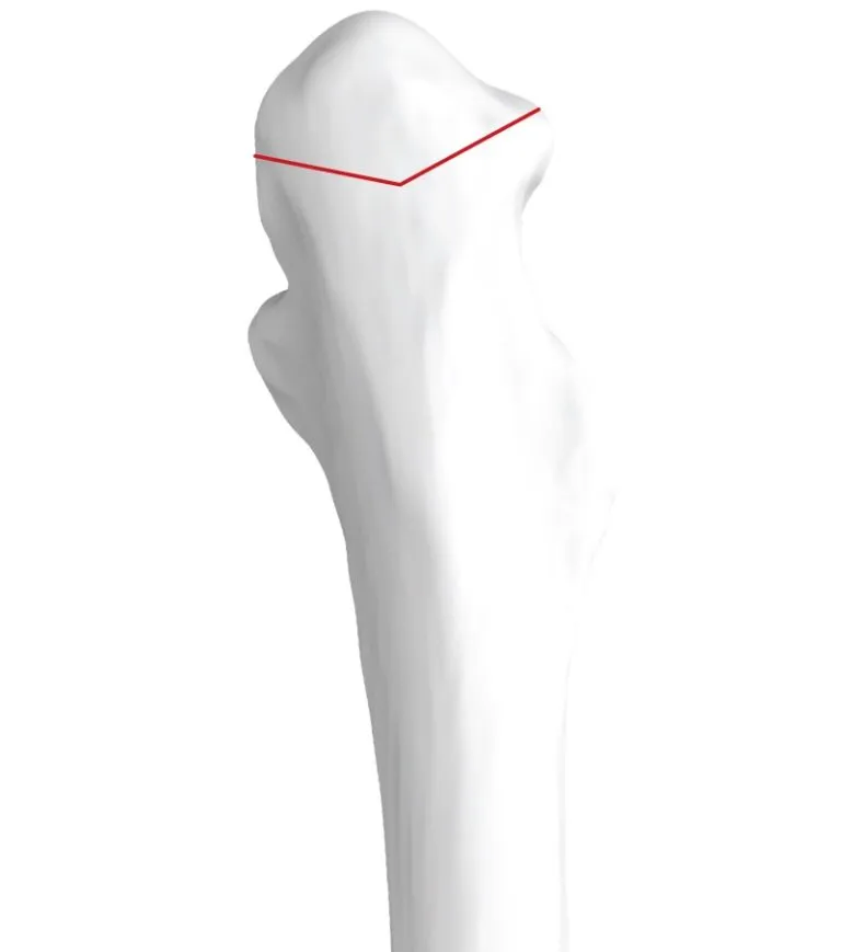 A diagram of the optimal placement of the chevron osteotomy