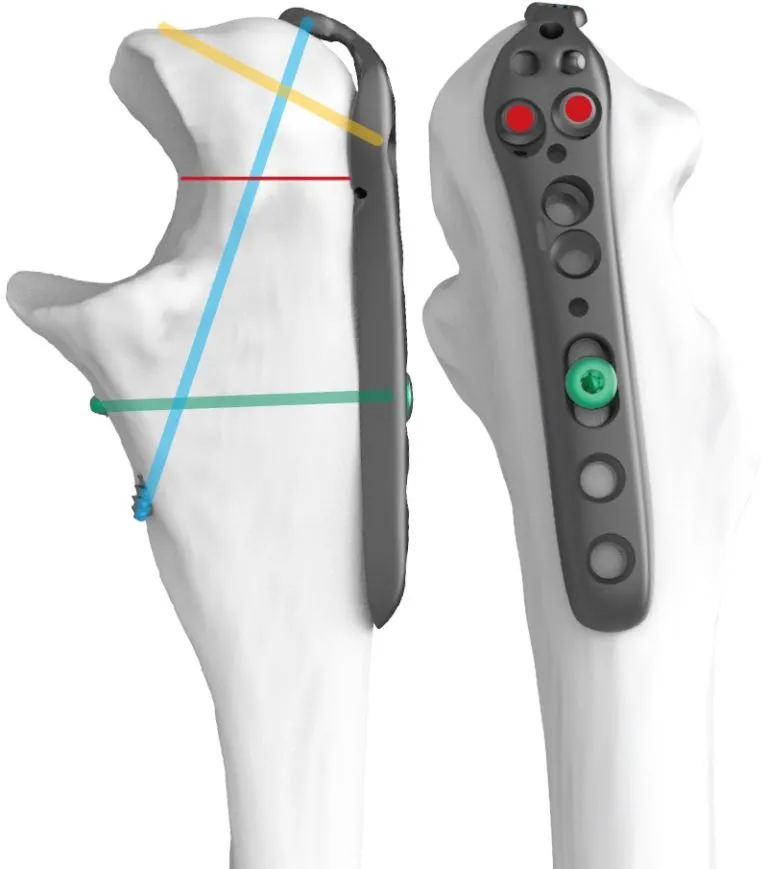 Diagram of the secure fixation at the osteotomy site via olecranon plate