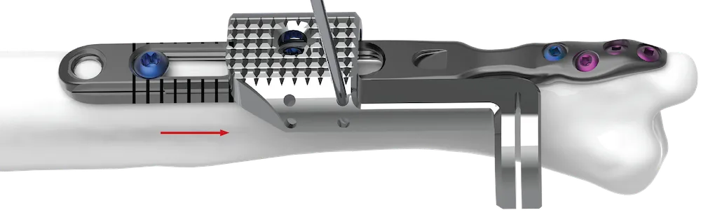 Slide the cutting guide to the most distal position, secure with a k-wire(s), and perform the first cut.