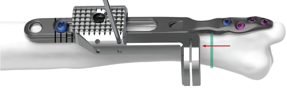Slide the cutting guide proximally to the desired shortening length, re-secure with a k-wire(s), perform the second cut, and remove the cutting guide.