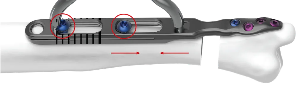 Remove the bone wedge, loosen the slot screws and compress the fragments using the compression forceps.