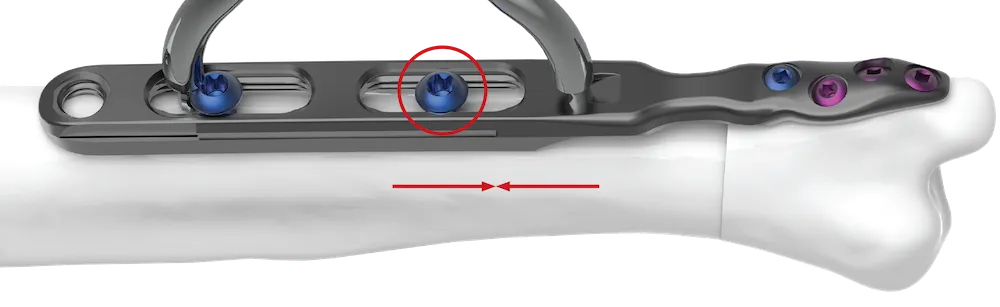 Retighten the most distal slot screw while maintaining compression with the forceps.